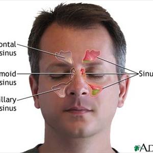 Sinusitis Natural Cure - The Top Sinus Allergy Causes