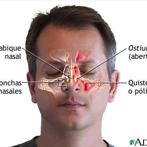 Sinusitis Frontales - Home Treatment For Sinus Infection