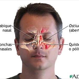 Sinusitis Frontales 