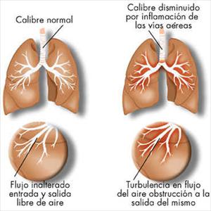 Fungal Sinusitis Ppt - Sinus Infection And Dizziness Symptoms 