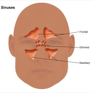 Acute Sinusitis Prognosis - Infections That Cause Bad Breath