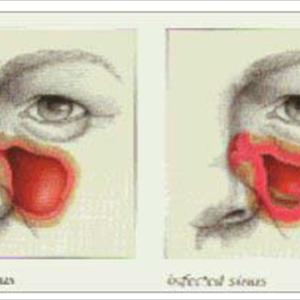 Of Sphenoidal Sinus - Infectious And Non-Infectious Causes Of Sinusitis - Part One