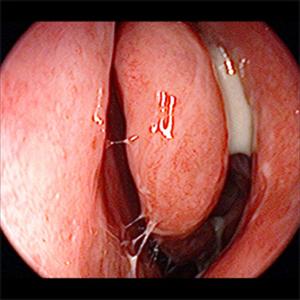 Sinusitis Dizziness Headache - Overuse Of Antibiotics For Children With Sinusitis