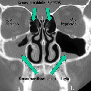 Sinuses Cause Neck Pain - Are You Being Troubled By Sinusitis?