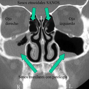  Are You Being Troubled By Sinusitis?