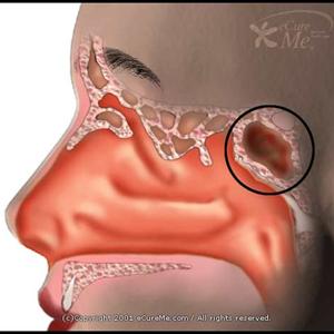  Sinusitis And Antibiotics Do Not Go Hand In Hand All The Time