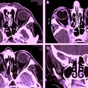 Sinusitis Ear Pain - Sinus Laser Surgery "Changed My Life" Said One Patient