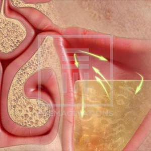 Sinus Nasal Polyps - Symptoms Of Severe Sinus Disease