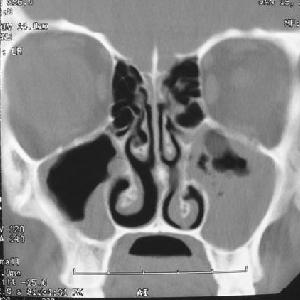 Sinusitis Agua - Sinusitis And Its Symptoms