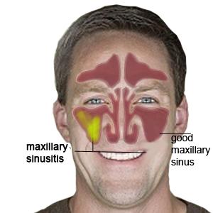 Acute Sinusitis Cause - Learning How To Treat Sinus Infection Effectively And Safely