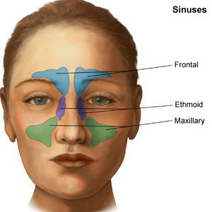 Left Maxillary Sinusitis - Sinus Problems: How To Treat Effectively