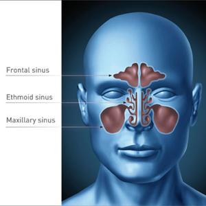 Sinus Blockage - Sinus And Allergy Induced Tinnitus - Can This Tinnitus Be Cured?