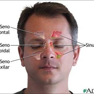 Sinus Flusher - Sinus Infection- Sinusitis