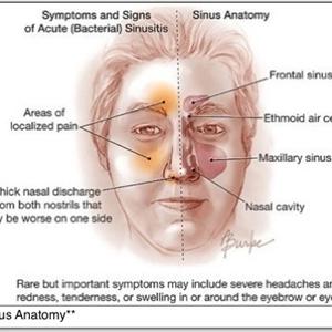 Drug Sinusitis - Deviated Septum- Think Twice About An Operation