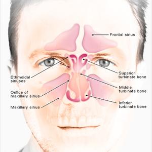 Inflammation Of Sinuses - Bacterial Sinus Infection Symptoms - How To Get To Know Of A Bacterial Sinus Infection