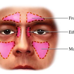 Sinusitis Holistic Treatment 