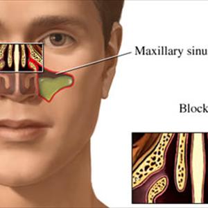 Dry Eyes Sinusitis 