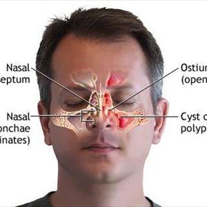  Sinusitis