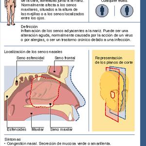 Severe Sinusitis 