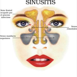 Bad Smell Sinuses - How To Treat Sinus Infection - Effective Remedy For Curing Sinus Problems Naturally