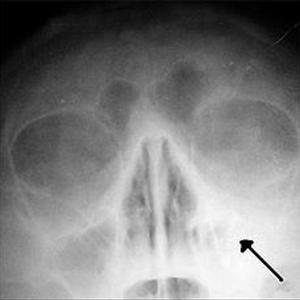 Sphenoid Sinuses Pain - How To Treat Sinus Infection - Remedial Measures For Sinus Infection