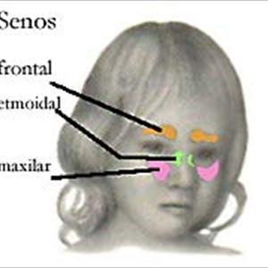 Pressure In Sinus Cavities - Natural Cure For Sinus Infection