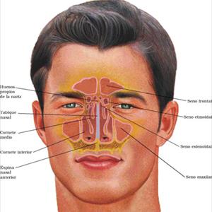 Sphenoid Sinus Block Symptoms 