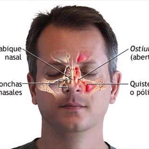 Sinusitis Agudas - Antibiotics For Sinus Infection