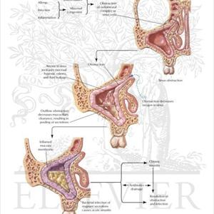 Chronic Sinusitis Herbs - Sinusitis - Ayurvedic Herbal Treatment